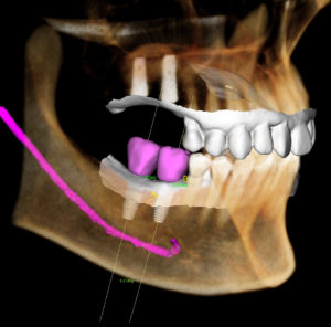 Dental Digital X-Rays
